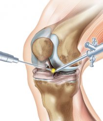 АРТРОСКОПИЧЕСКАЯ ХИРУРГИЯ В ГЕРМАНИИ