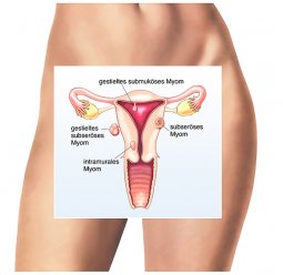 МИОМА: ЛЕЧИТЬ ИЛИ ПОДОЖДАТЬ?