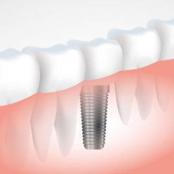 ЗУБНЫЕ ИМПЛАНТЫ НОВОГО ПОКОЛЕНИЯ