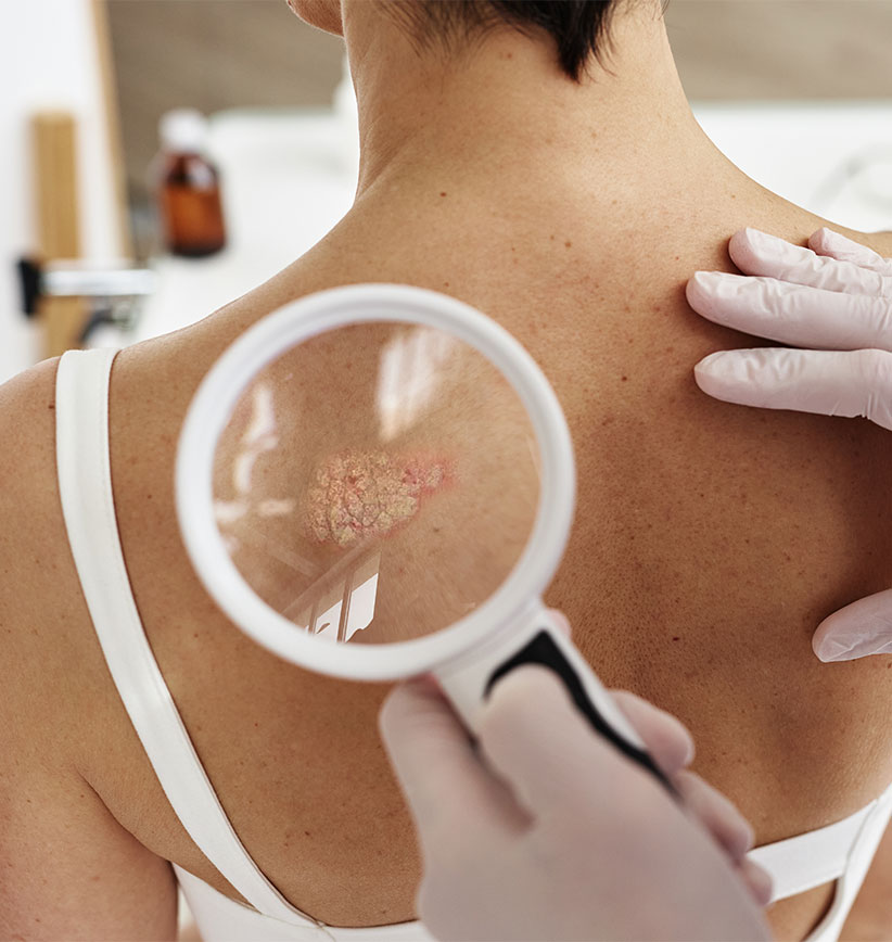 НИЗКОДОЗНАЯ ТЕРАПИЯ МЕЛАНОМЫ