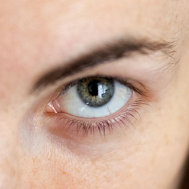 НОВОЕ ЛЕЧЕНИЕ ДИСТРОФИИ СЕТЧАТКИ ГЛАЗА