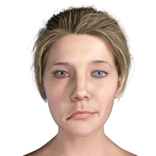 ПОБЕДИТЬ ПАРАЛИЧ ЛИЦЕВОГО НЕРВА