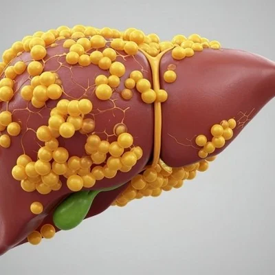 ЖИРОВАЯ БОЛЕЗНЬ ПЕЧЕНИ