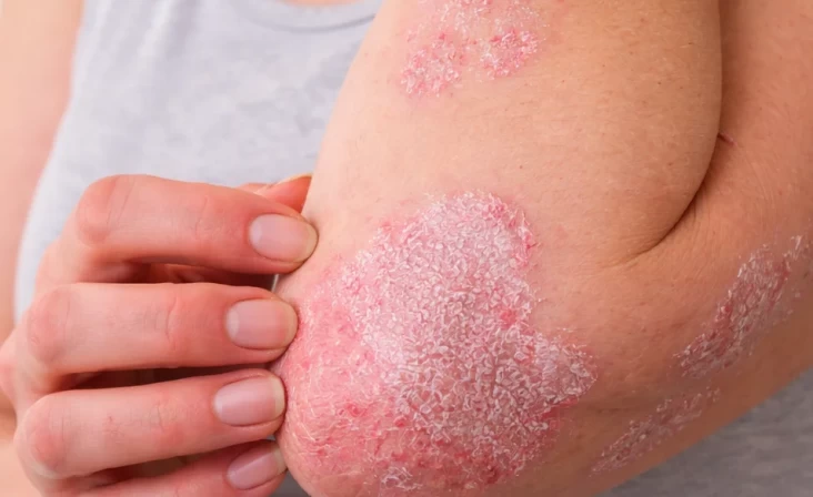 МОЖНО ЛИ ВЫЛЕЧИТЬ ПСОРИАЗ?